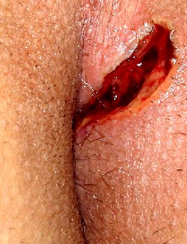 Fistula-in-ano After Surgery